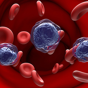 Acute myeloid leukemia