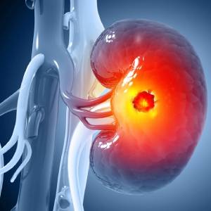 Kidney Cancer Treatment in Vijayawada