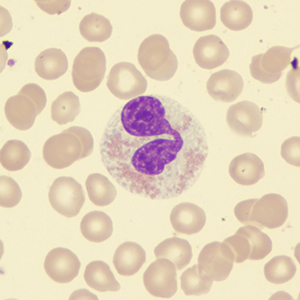 Myelodysplastic syndrome