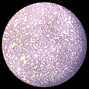 Pancytopenia