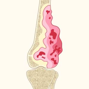 Sarcoma Treatment in Vijayawada